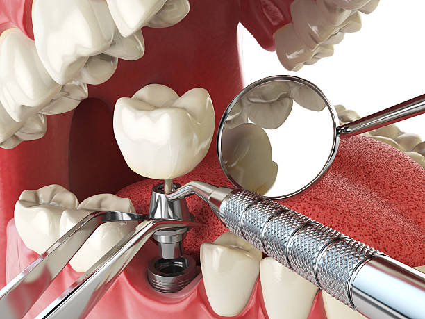 Best Emergency Wisdom Teeth Removal in Walcott, IA